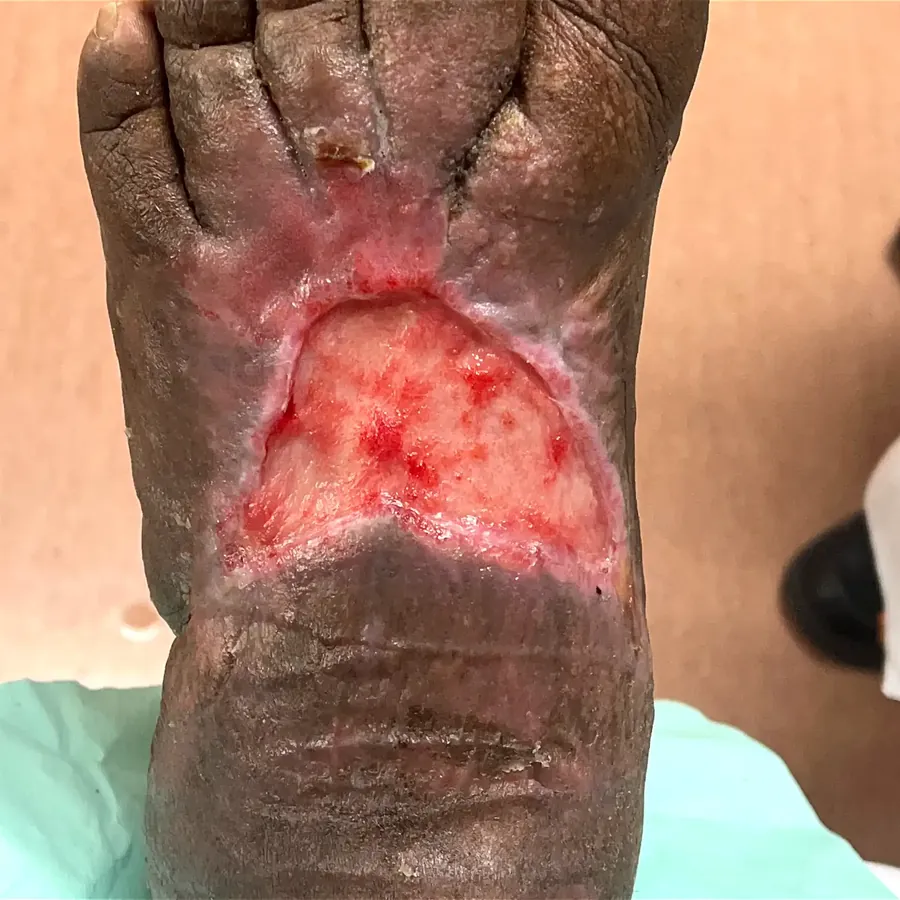 Clinical photograph of a diabetic foot wound at visit 1, HKL-53
