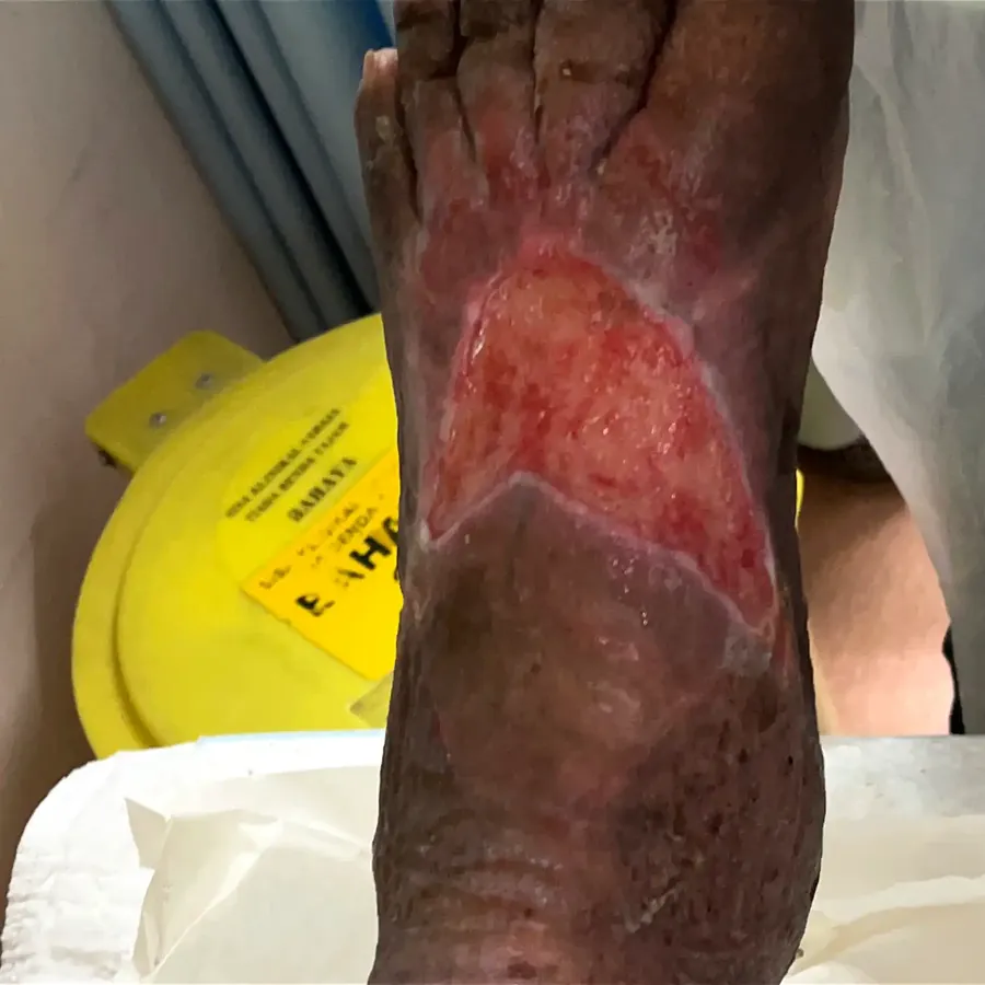 Clinical photograph of a diabetic foot wound at visit 2, HKL-53