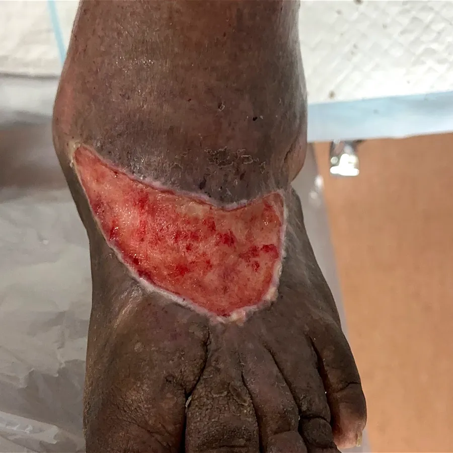 Clinical photograph of a diabetic foot wound at visit 3, HKL-53