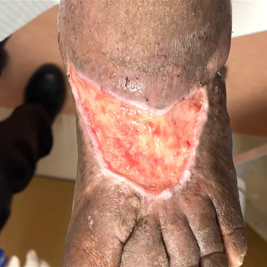 Clinical photograph of a diabetic foot wound at visit 4, HKL-53