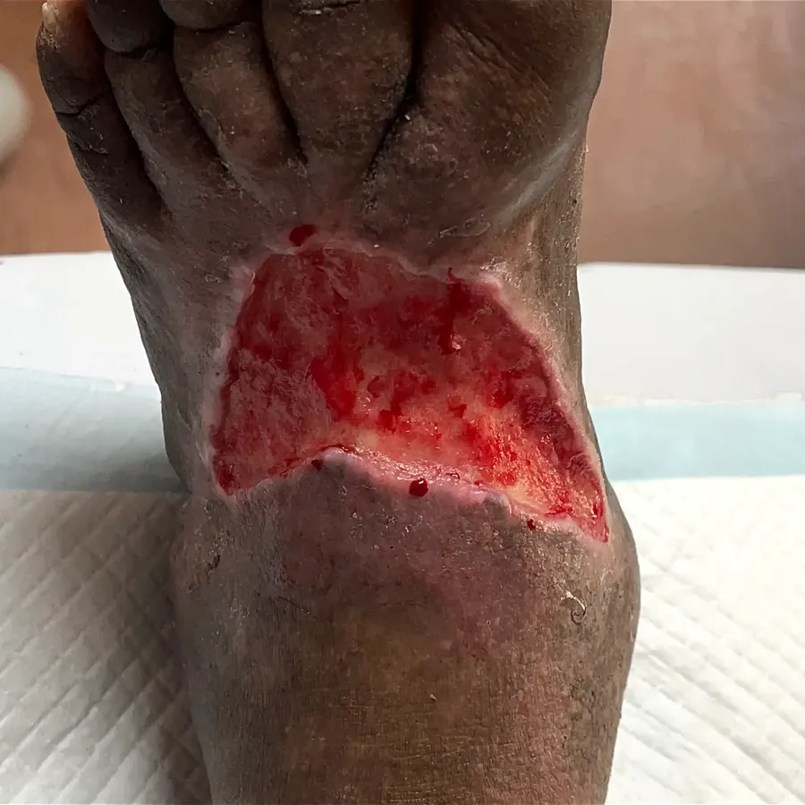 Clinical photograph of a diabetic foot wound at visit 5, HKL-53