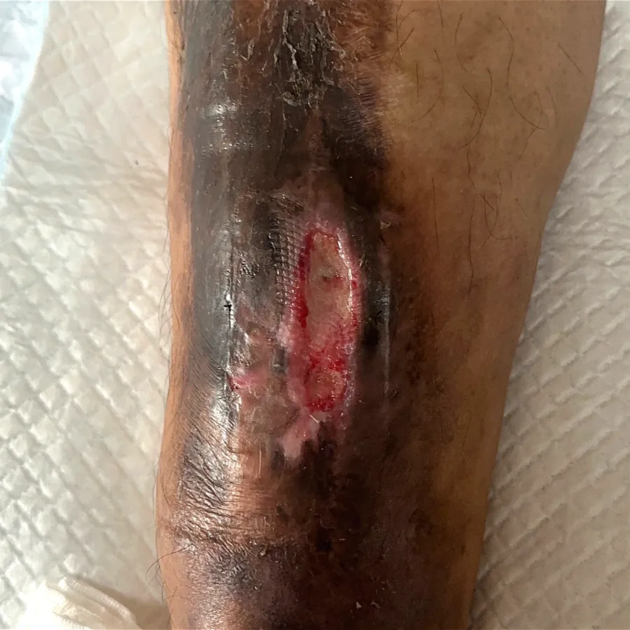 Clinical photograph of a trauma-related leg wound at visit 1, HKL-54