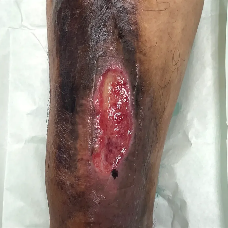 Clinical photograph of a trauma-related leg wound at visit 2, HKL-54