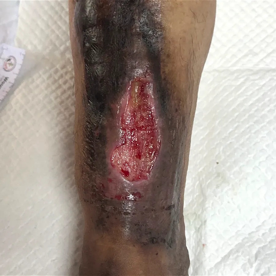 Clinical photograph of a trauma-related leg wound at visit 3, HKL-54