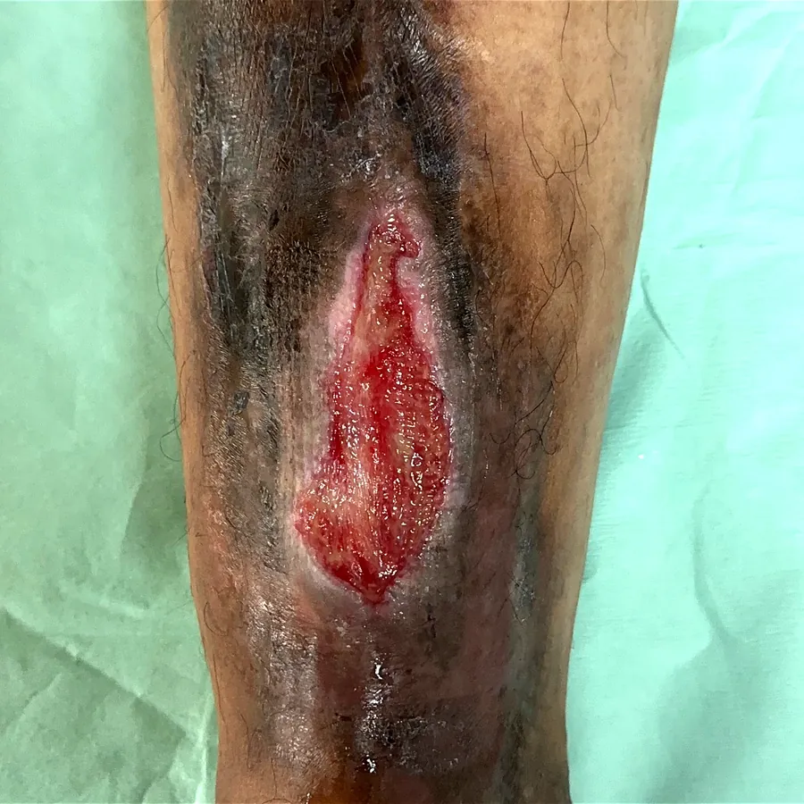 Clinical photograph of a trauma-related leg wound at visit 4, HKL-54