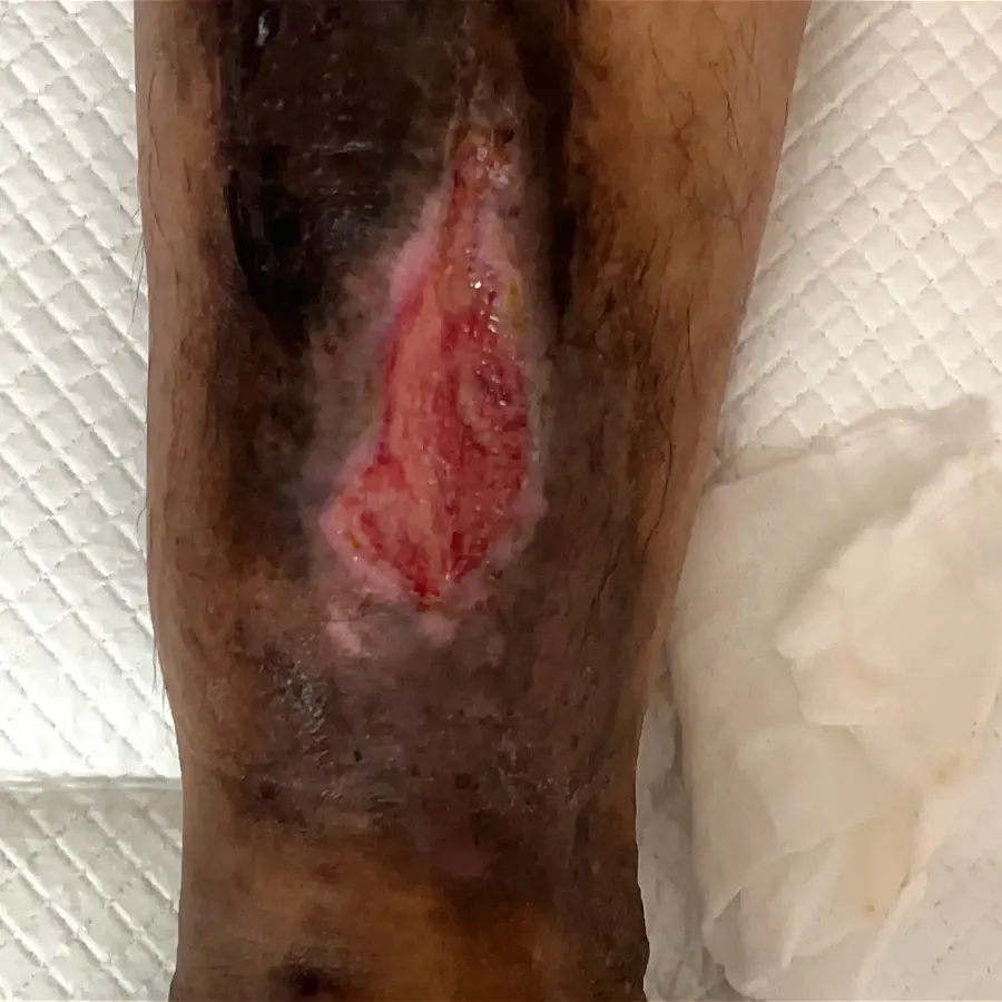 Clinical photograph of a trauma-related leg wound at visit 5, HKL-54