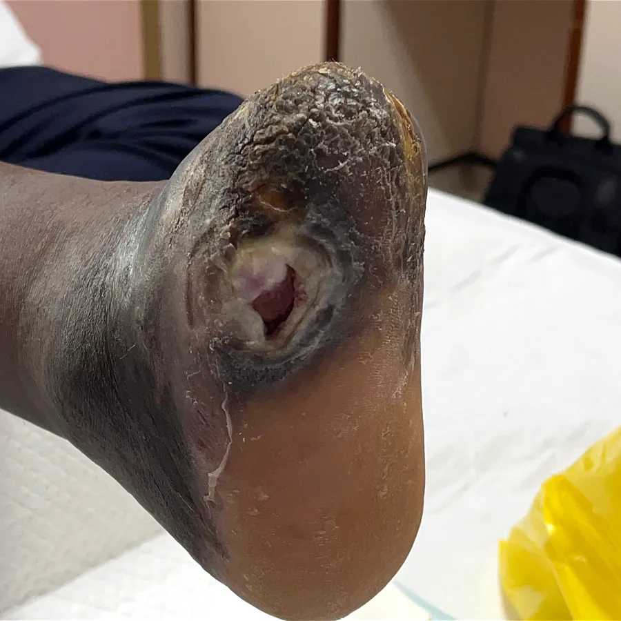 Clinical photograph of a diabetic plantar wound at visit 1, HKL-55