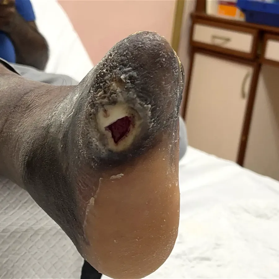Clinical photograph of a diabetic plantar wound at visit 2, HKL-55