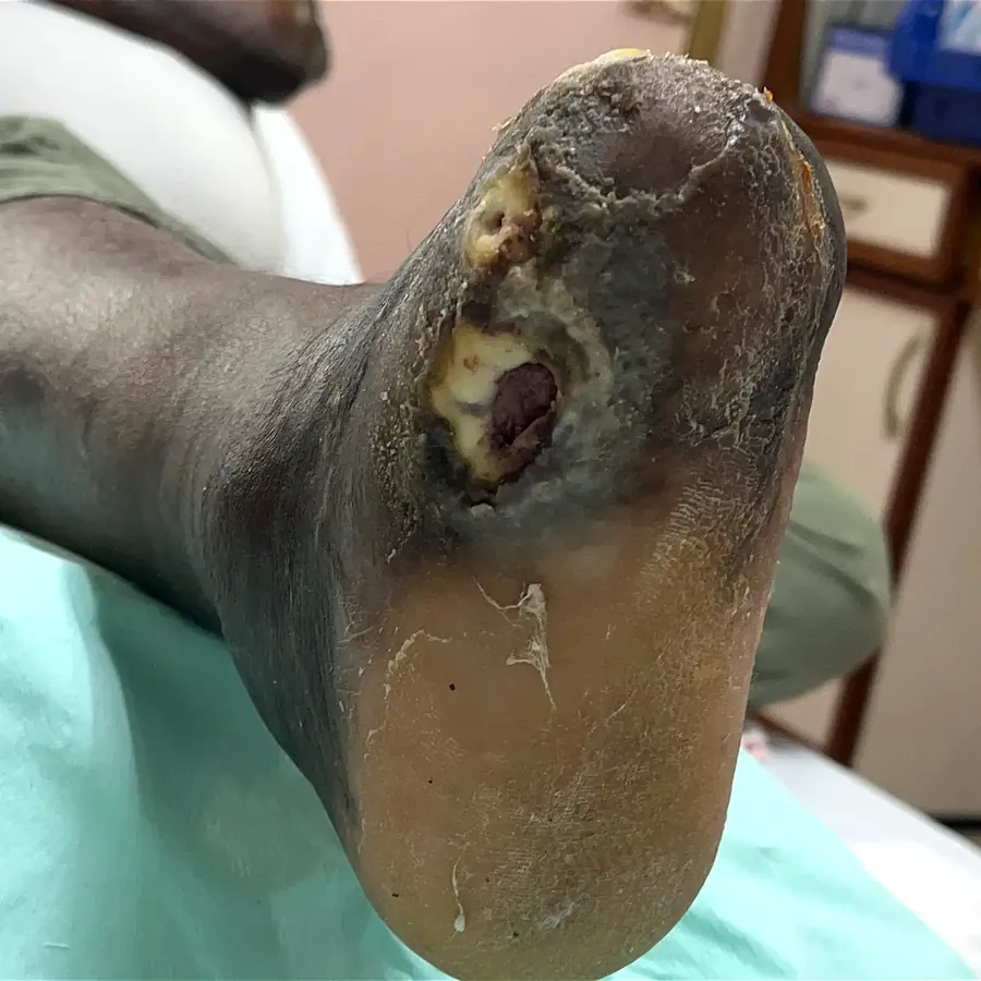 Clinical photograph of a diabetic plantar wound at visit 3, HKL-55