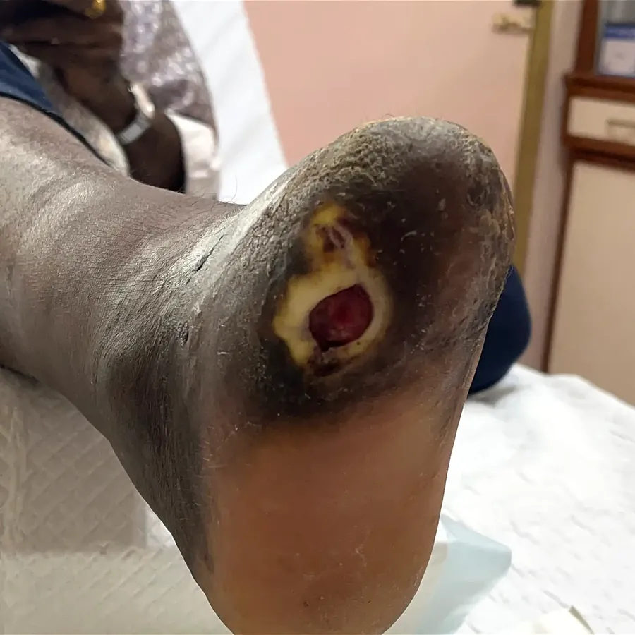 Clinical photograph of a diabetic plantar wound at visit 4, HKL-55