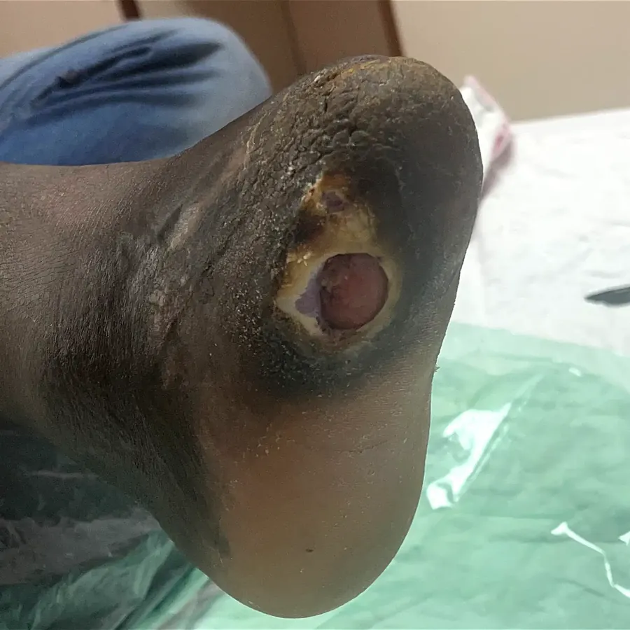 Clinical photograph of a diabetic plantar wound at visit 5, HKL-55