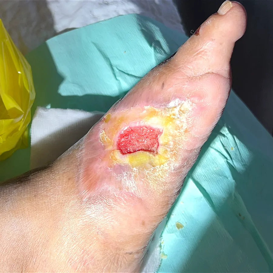 Clinical photograph of a diabetic plantar wound at visit 1, HKL-56