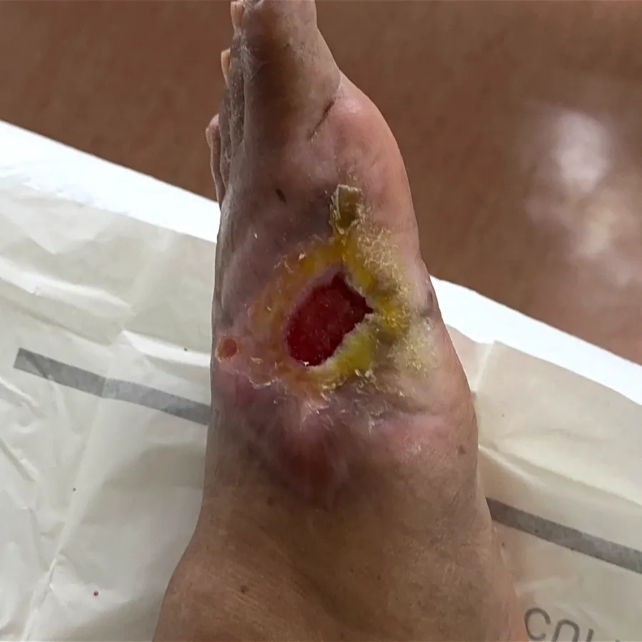 Clinical photograph of a diabetic plantar wound at visit 2, HKL-56
