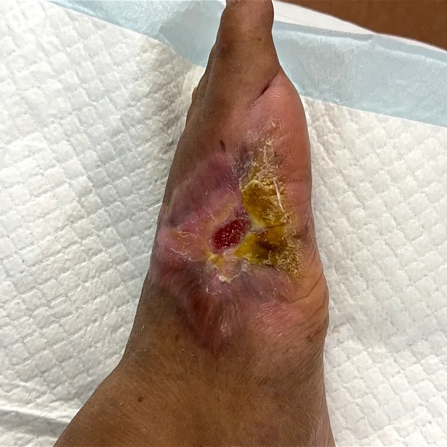 Clinical photograph of a diabetic plantar wound at visit 3, HKL-56