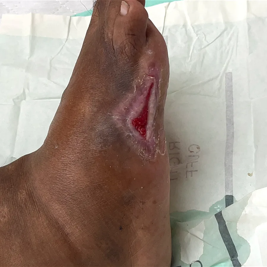 Clinical photograph of a diabetic plantar wound at visit 1, HKL-57