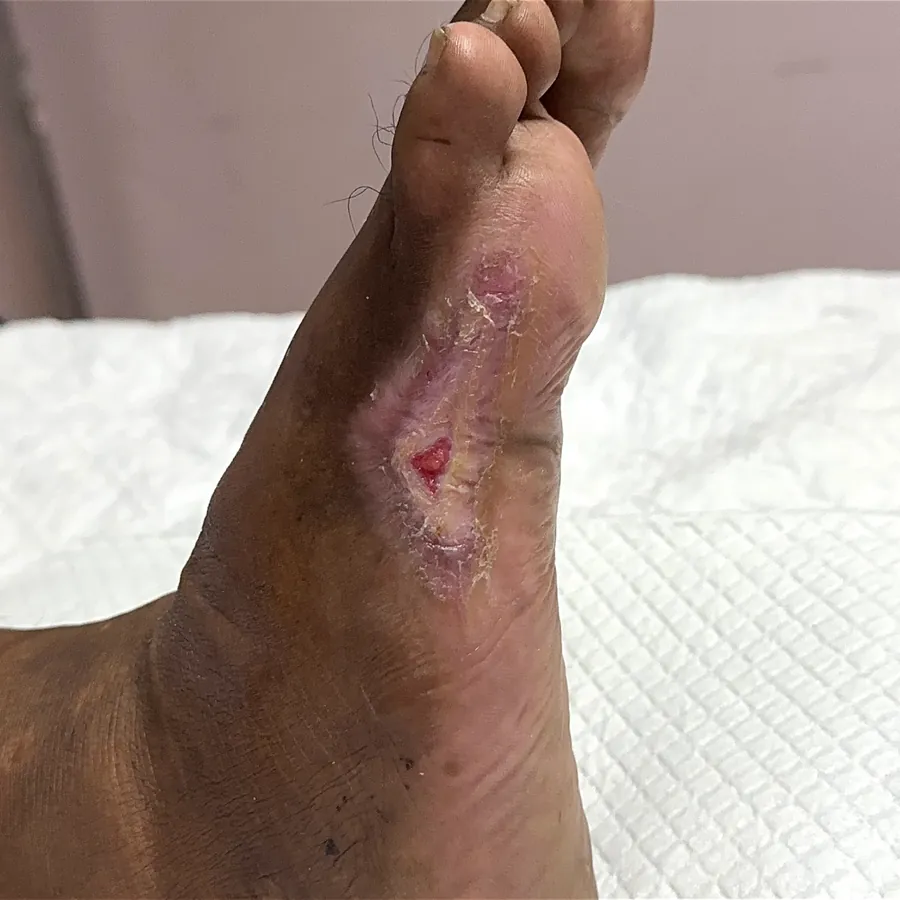 Clinical photograph of a diabetic plantar wound at visit 2, HKL-57
