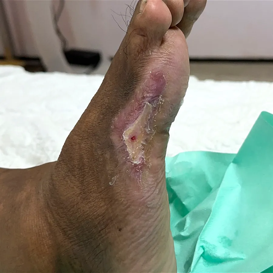 Clinical photograph of a diabetic plantar wound at visit 3, HKL-57