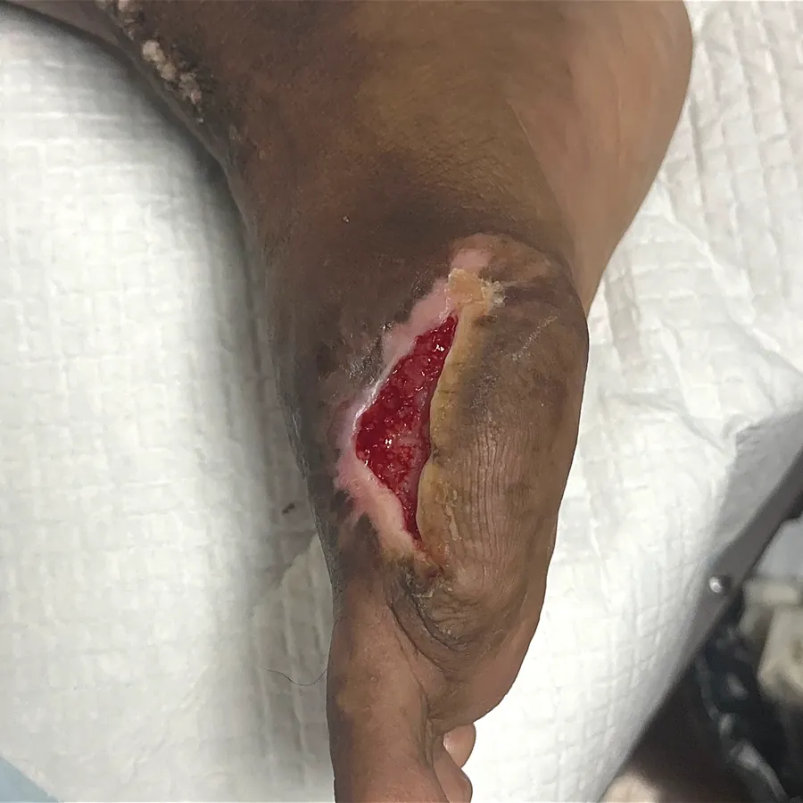 Clinical photograph of a diabetic foot wound at visit 1, HKL-58