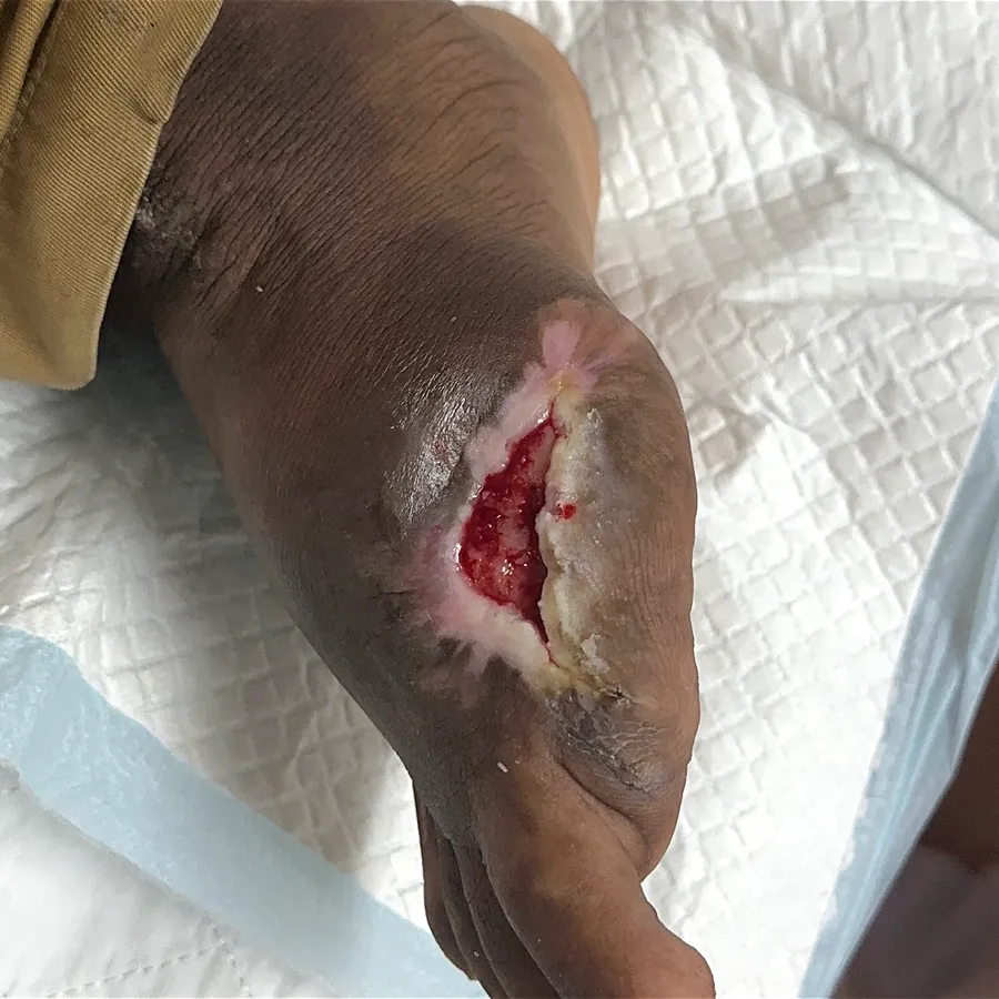 Clinical photograph of a diabetic foot wound at visit 2, HKL-58