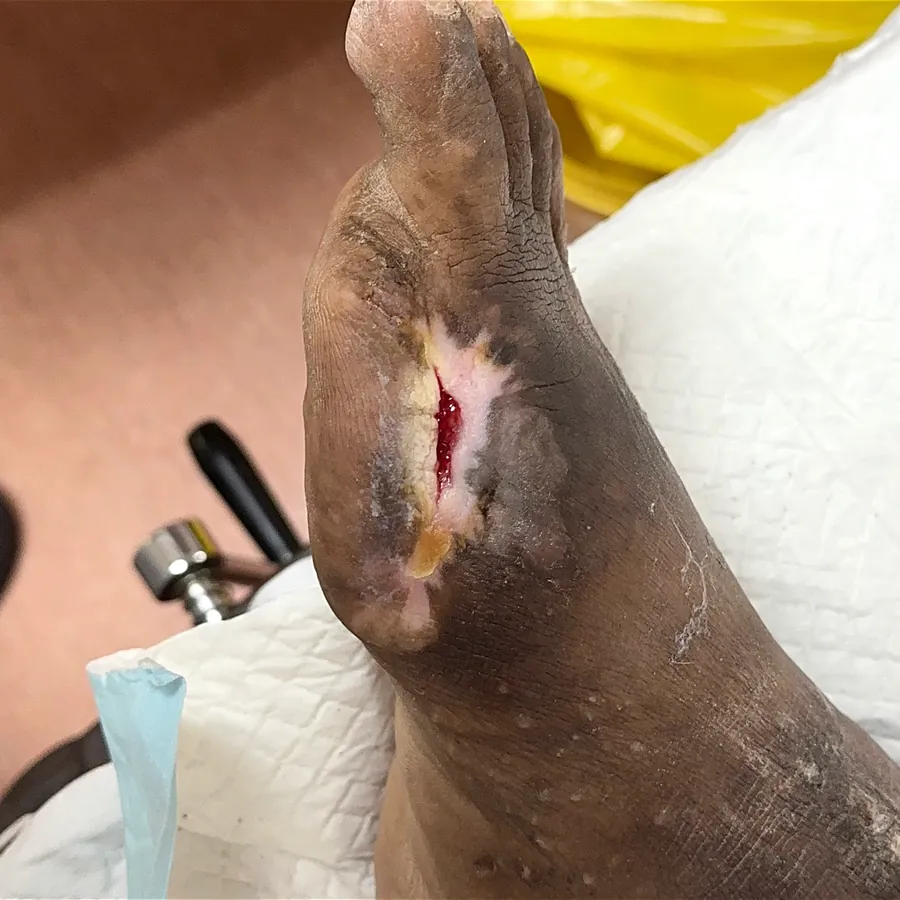 Clinical photograph of a diabetic foot wound at visit 3, HKL-58