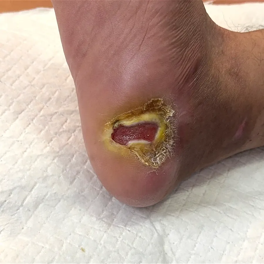 Clinical photograph of a diabetic heel wound at visit 1, HKL-59