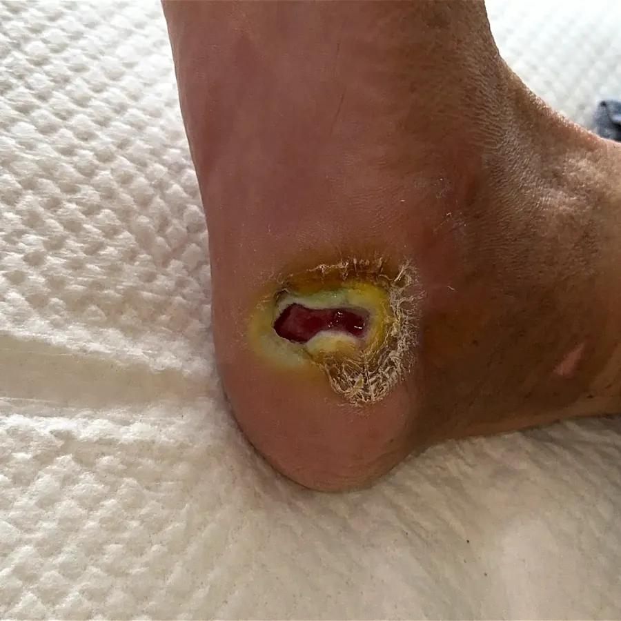 Clinical photograph of a diabetic heel wound at visit 2, HKL-59