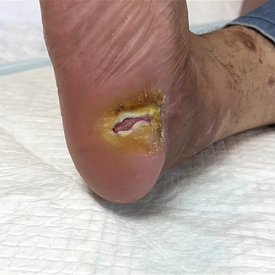 Clinical photograph of a diabetic heel wound at visit 3, HKL-59