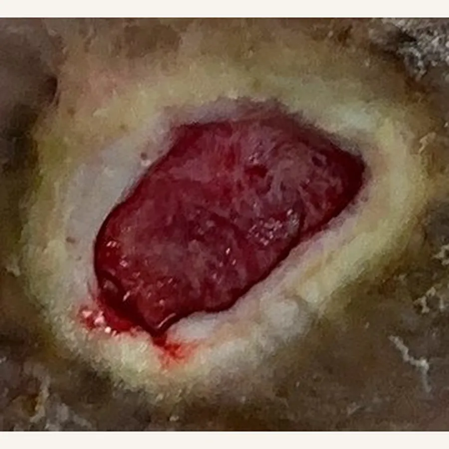 Clinical photograph of a diabetic plantar wound at visit 1, HKL-60