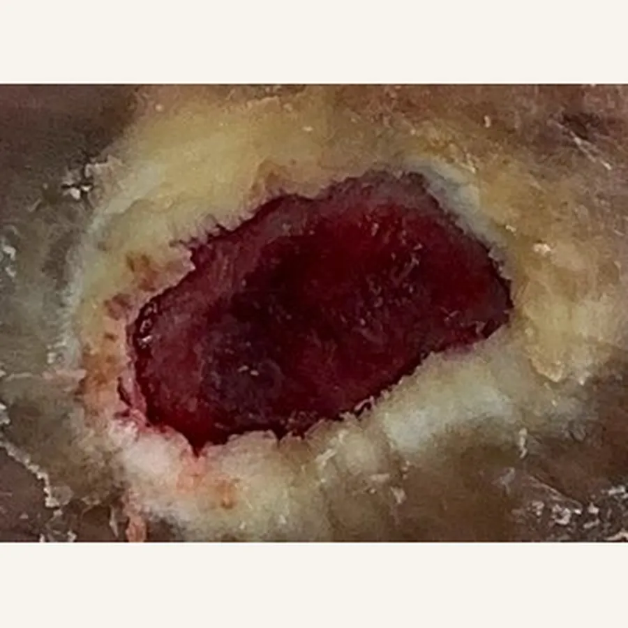Clinical photograph of a diabetic plantar wound at visit 2, HKL-60