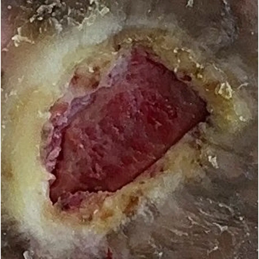 Clinical photograph of a diabetic plantar wound at visit 3, HKL-60
