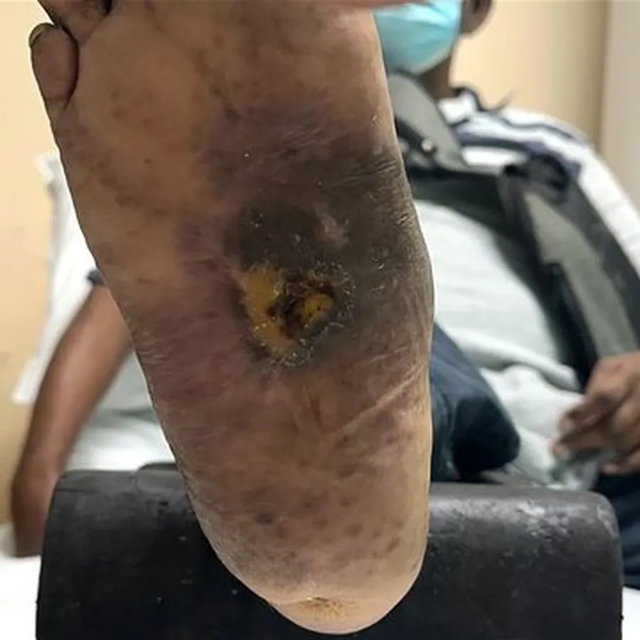 Clinical photograph of a diabetic plantar wound at visit 5, HKL-60