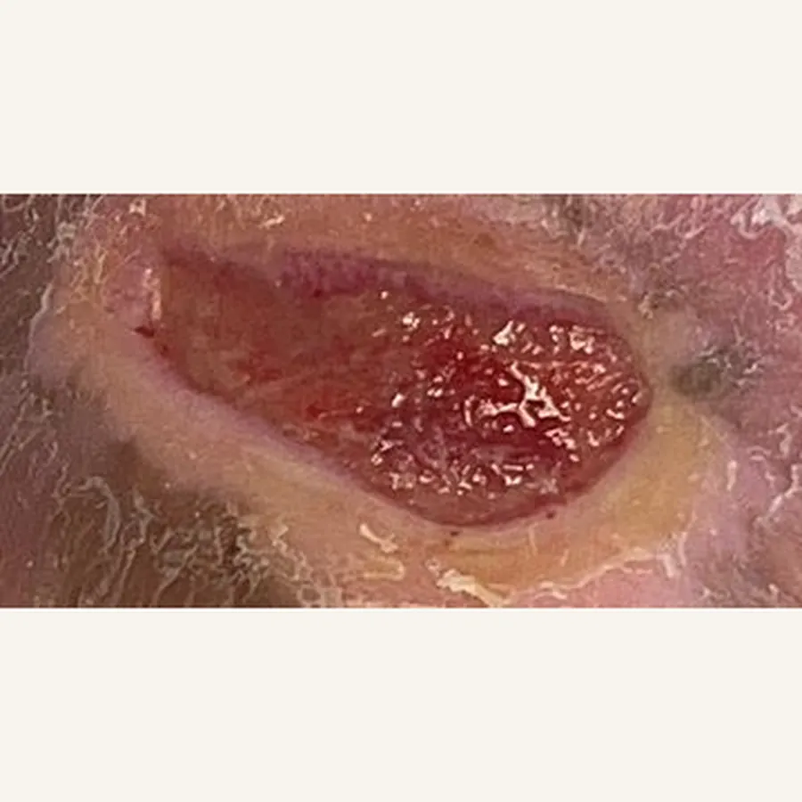 Clinical photograph of a diabetic foot wound at visit 1, HKL-61