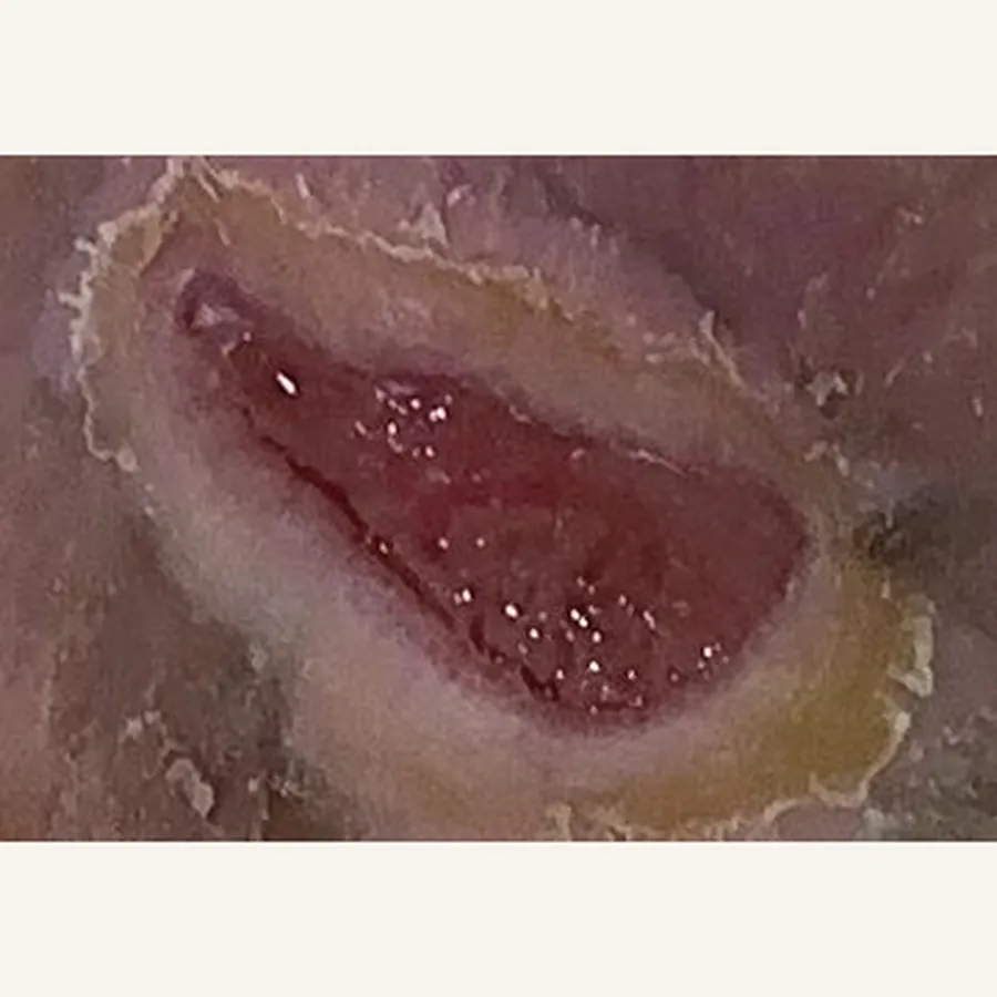 Clinical photograph of a diabetic foot wound at visit 2, HKL-61