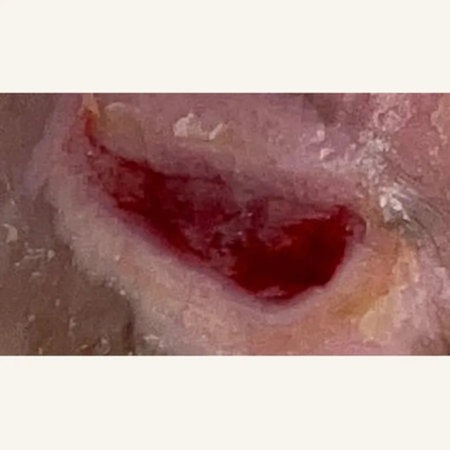 Clinical photograph of a diabetic foot wound at visit 3, HKL-61