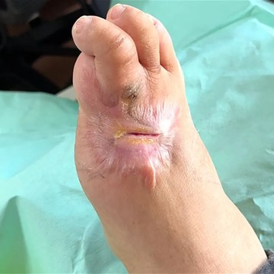 Clinical photograph of a diabetic foot wound at visit 5, HKL-61