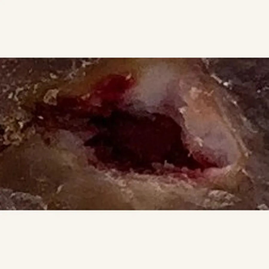 Clinical photograph of a diabetic heel wound at visit 1, HKL-62