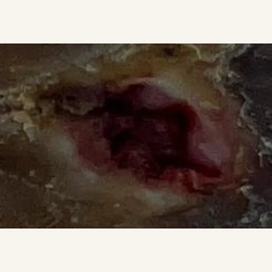 Clinical photograph of a diabetic heel wound at visit 2, HKL-62