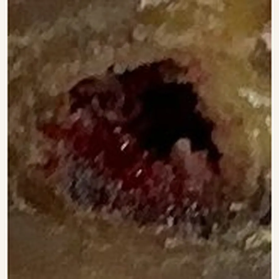 Clinical photograph of a diabetic heel wound at visit 3, HKL-62