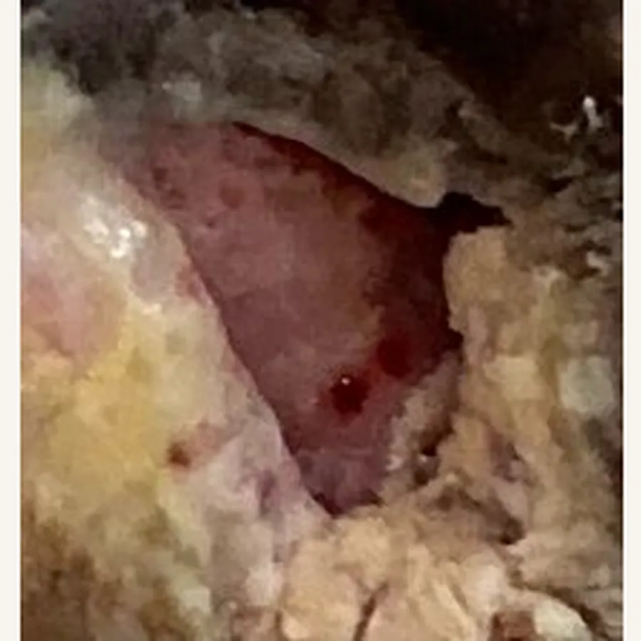 Clinical photograph of a diabetic plantar wound at visit 1, HKL-63