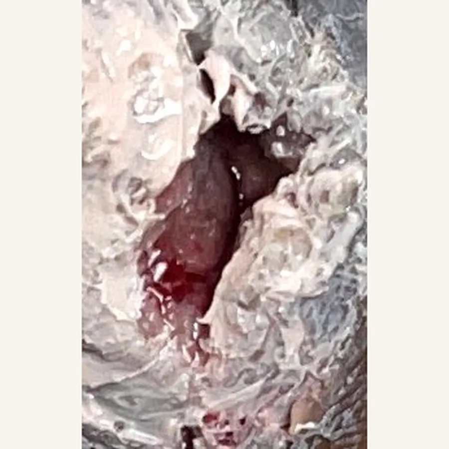 Clinical photograph of a diabetic plantar wound at visit 2, HKL-63