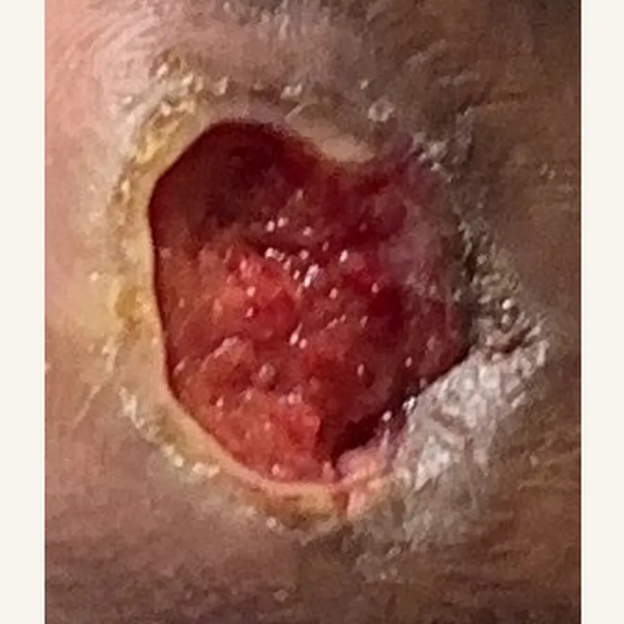 Clinical photograph of a diabetic foot wound at visit 1, HKL-64