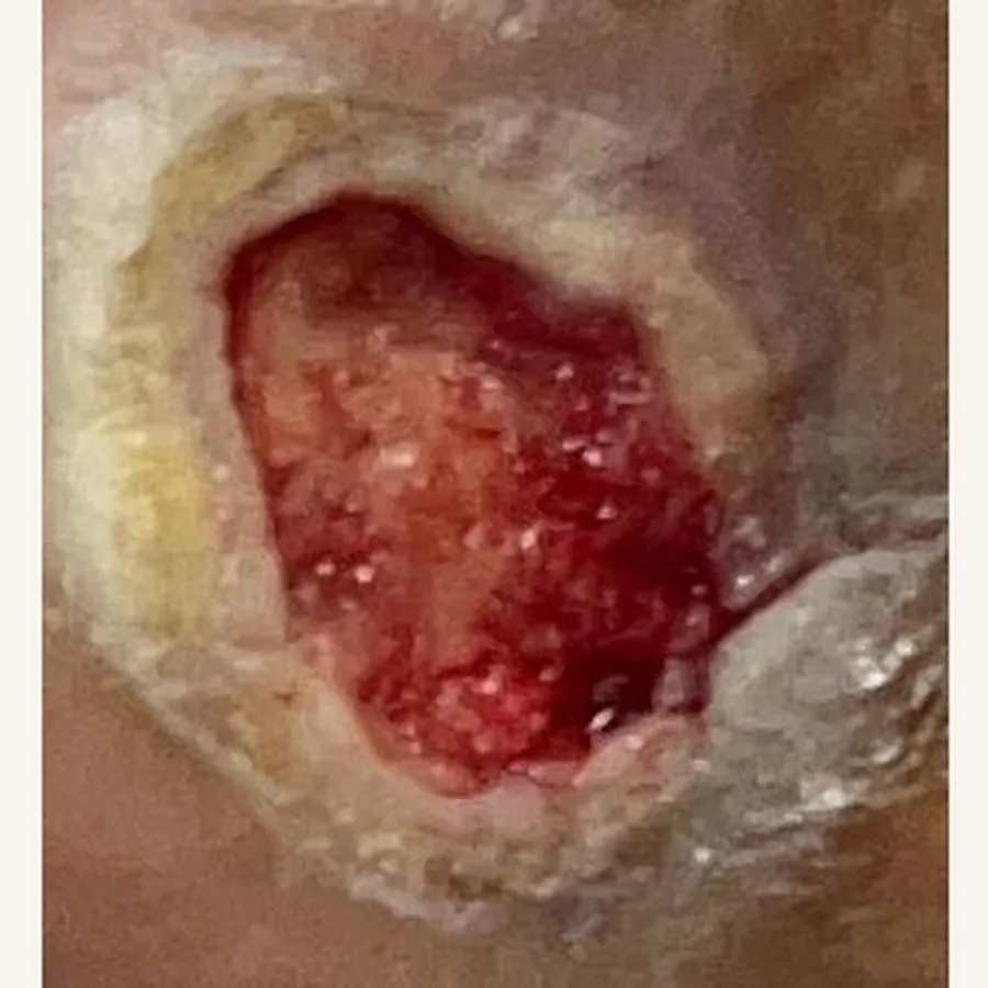 Clinical photograph of a diabetic foot wound at visit 2, HKL-64