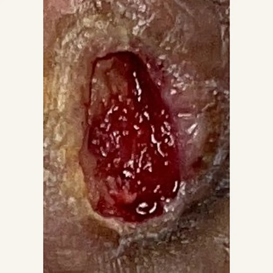 Clinical photograph of a diabetic foot wound at visit 3, HKL-64