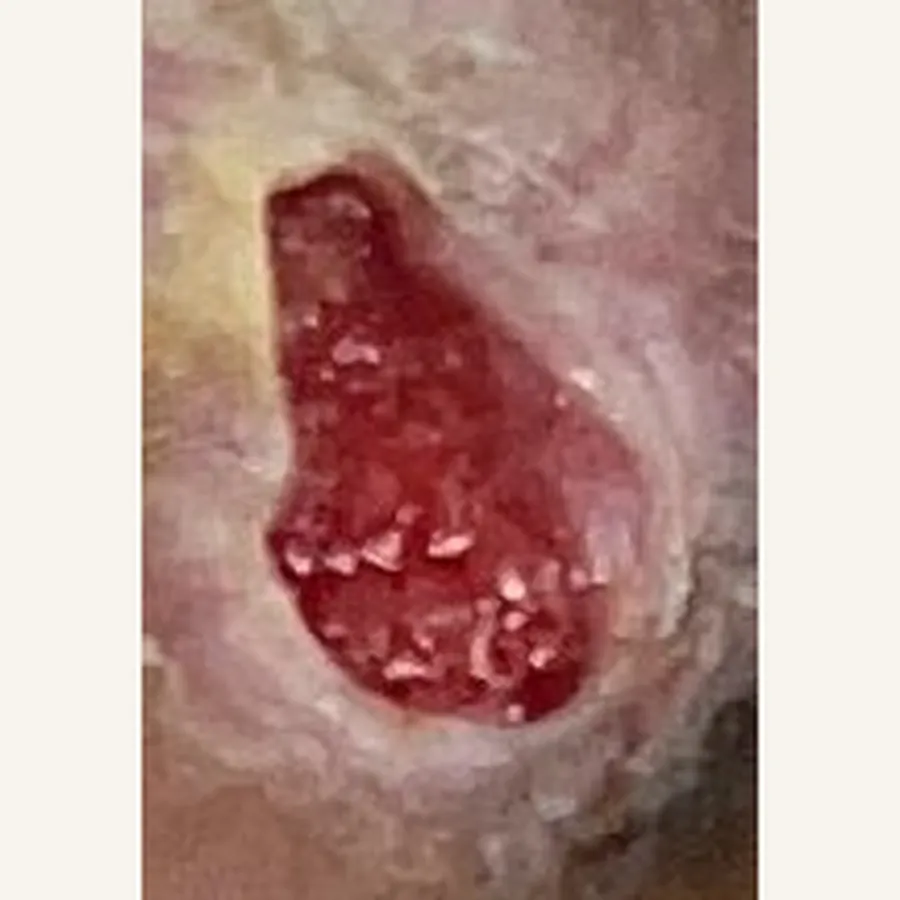 Clinical photograph of a diabetic foot wound at visit 4, HKL-64