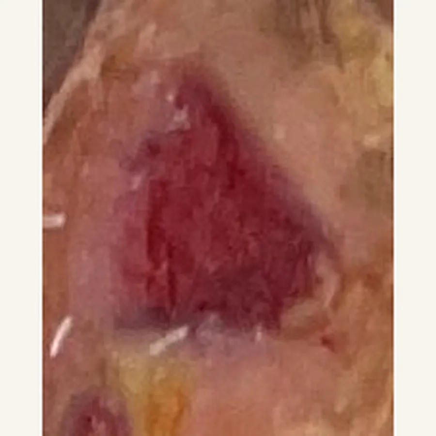 Clinical photograph of a diabetic plantar wound at visit 1, HKL-65