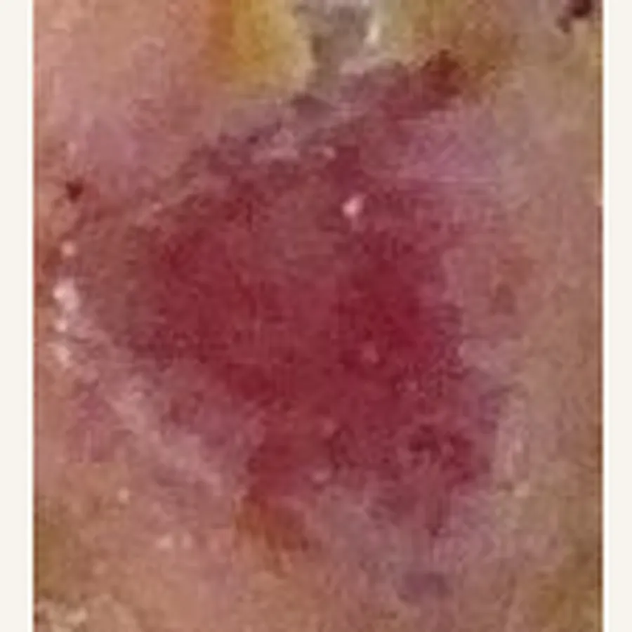 Clinical photograph of a diabetic plantar wound at visit 2, HKL-65