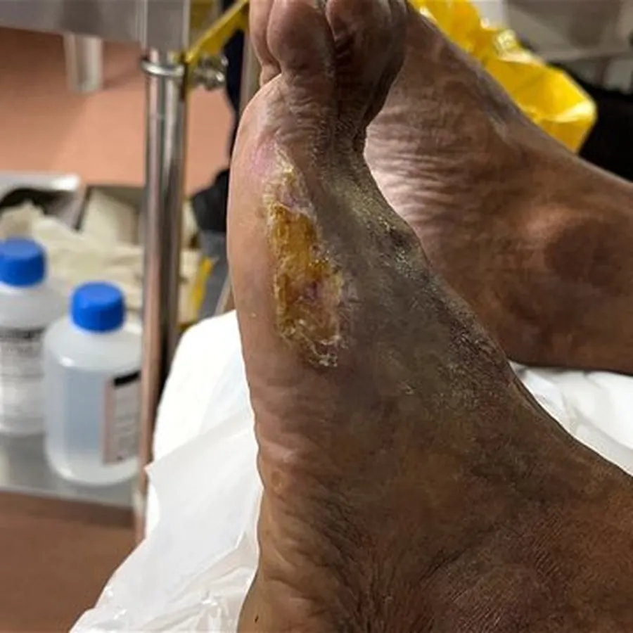 Clinical photograph of a diabetic plantar wound at visit 3, HKL-65