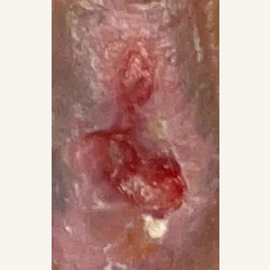 Clinical photograph of a diabetic leg wound at visit 1, HKL-66