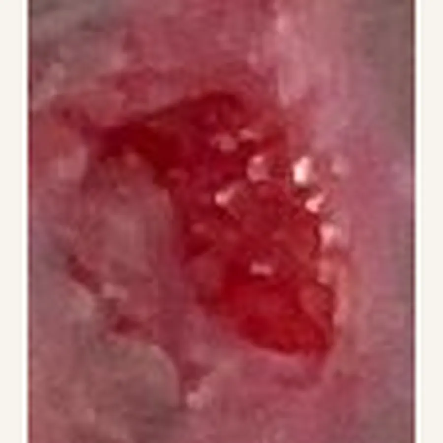 Clinical photograph of a diabetic leg wound at visit 2, HKL-66
