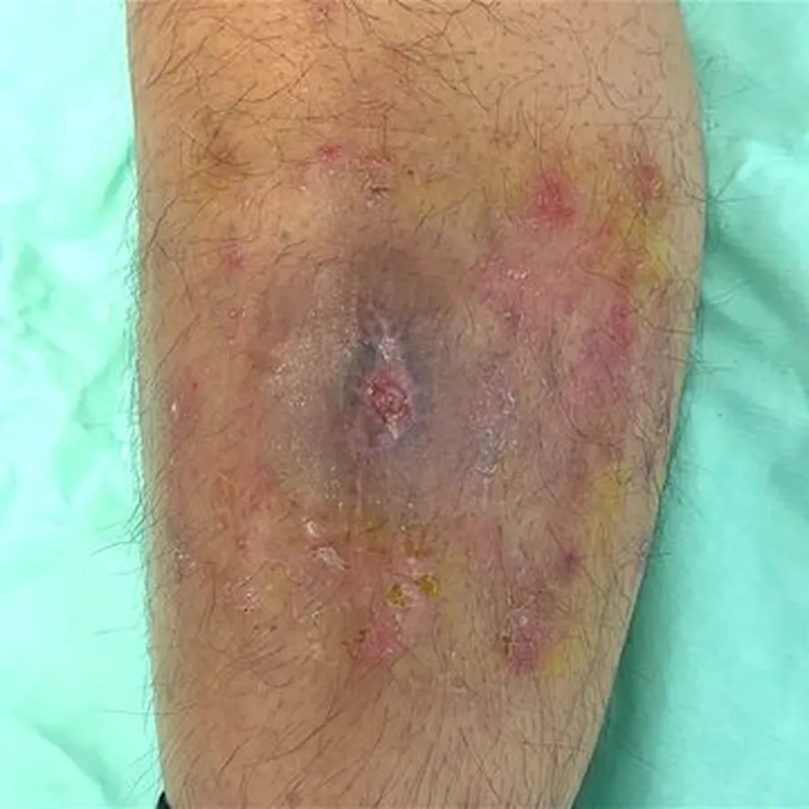 Clinical photograph of a diabetic leg wound at visit 3, HKL-66